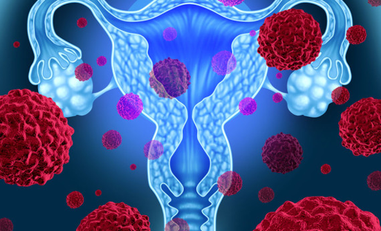 New Biomarker May Predict Risk for Uterine Cancer Recurrence