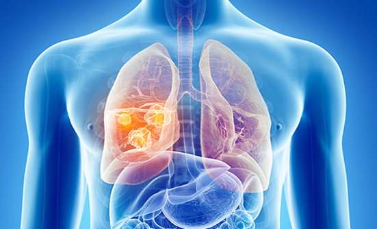 Where to Turn After You’ve Been Diagnosed with Lung Cancer