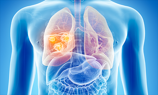 5 Things You Need to Know About Low-Dose CT Screening for Lung Cancer