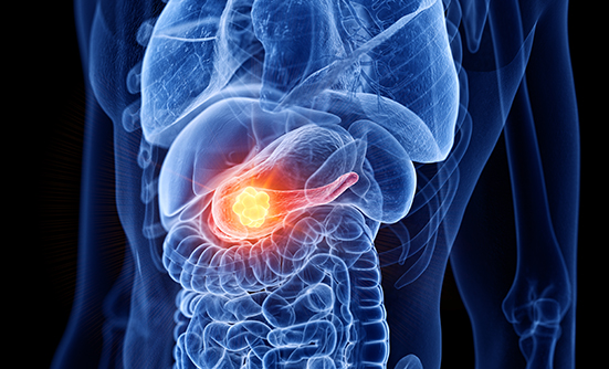 Why Is Pancreatic Cancer So Deadly? Looking for New Answers