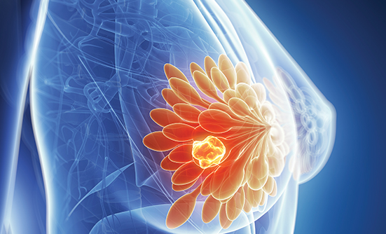 Immunotherapy plus Chemotherapy Extends Survival for Patients with Metastatic Triple-Negative Breast Cancer