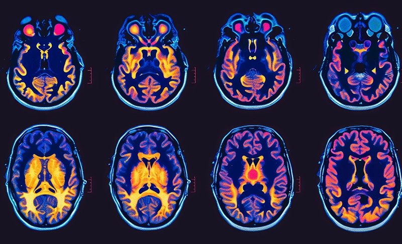 Brain Tumors Decoded: A Comprehensive Guide for Patients and Caregivers